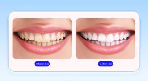 Teeth Whitening